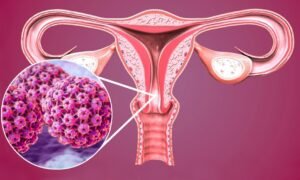 Câncer de Colo de Útero: A Importância Vital do Papanicolau na Detecção Precoce