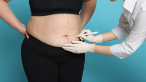 Plano de saúde cobre cirurgia bariátrica? Guia completo em 2026 Plano de saúde cobre cirurgia bariátrica? Guia completo em 2026
