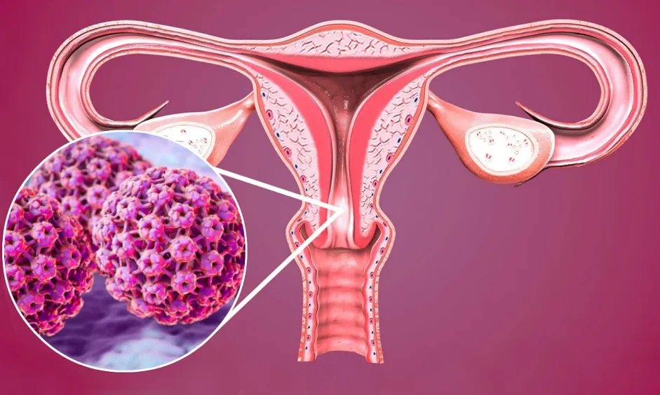 Câncer de Colo de Útero: A Importância Vital do Papanicolau na Detecção Precoce Câncer de Colo de Útero: A Importância Vital do Papanicolau na Detecção Precoce